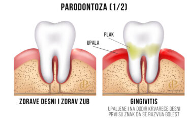 parodontoza-1