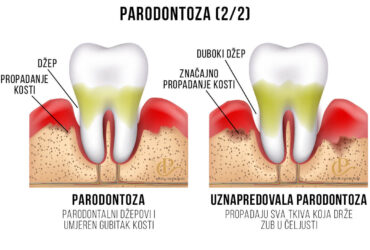 parodontoza-2
