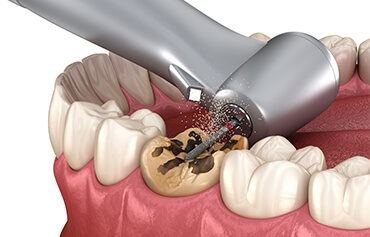 Restaurativa i endodoncija