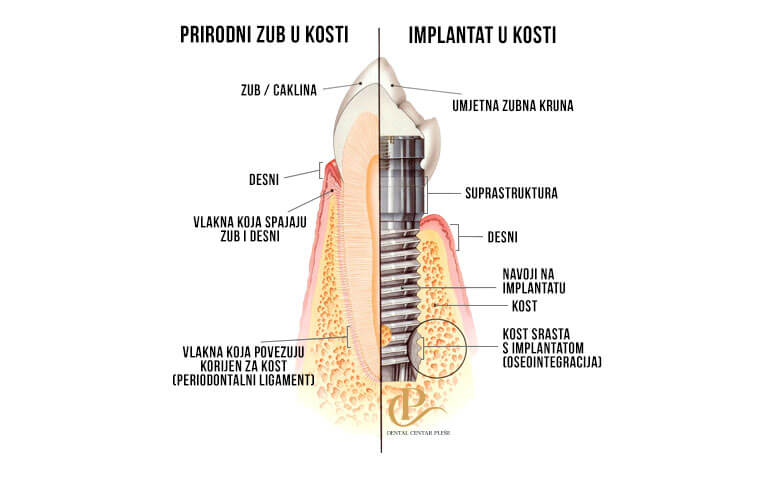 zubni-implantat